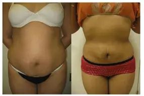 Before and after of abdomen liposuction by Dr. Drew Varano in Washington DC